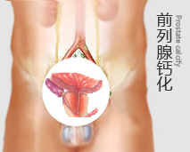 前列腺钙化