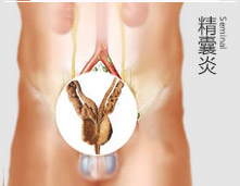 精囊炎