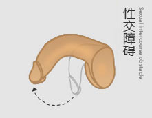 性交功能障碍