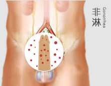 非淋