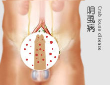 支原体感染